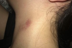 Cách làm mờ vết hickey