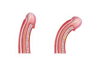 Dương vật cong hay thẳng tốt hơn